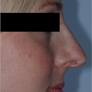 Rhinoplasty Before and After Pictures Bucks County, PA, and Hunterdon County, NJ