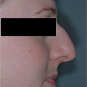 Rhinoplasty Before and After Pictures Bucks County, PA, and Hunterdon County, NJ