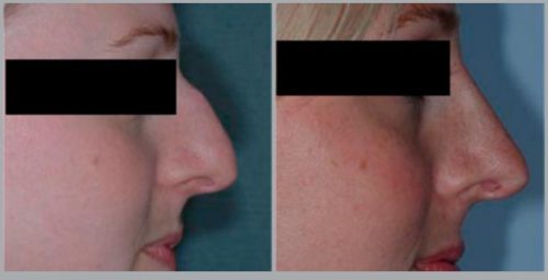 Rhinoplasty Before and After Pictures Bucks County, PA, and Hunterdon County, NJ