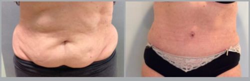 Tummy Tuck Before and After Pictures Bucks County, PA, and Hunterdon County, NJ
