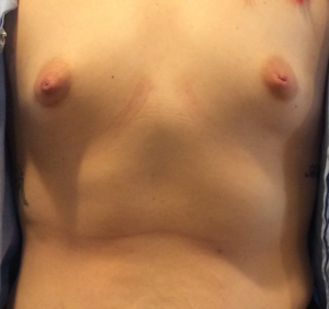 Breast Augmentation Before and After Pictures Bucks County, PA and Hunterdon County, NJ