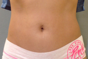 Coolsculpting Before and After Pictures Bucks County, PA and Hunterdon County, NJ