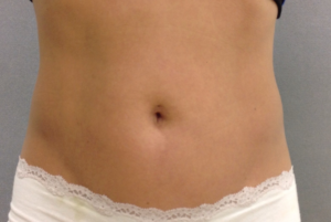 Coolsculpting Before and After Pictures Bucks County, PA and Hunterdon County, NJ