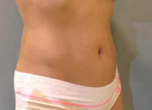 Coolsculpting Before and After Pictures Bucks County, PA and Hunterdon County, NJ