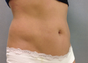 Coolsculpting Before and After Pictures Bucks County, PA and Hunterdon County, NJ