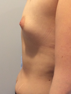 Breast Augmentation Before and After Pictures Bucks County, PA, and Hunterdon County, NJ