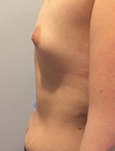 Breast Augmentation Before and After Pictures Bucks County, PA and Hunterdon County, NJ