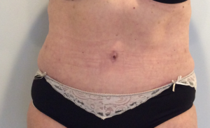 Tummy Tuck Before and After Pictures Bucks County, PA, and Hunterdon County, NJ