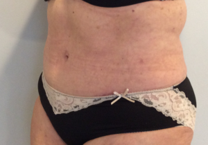 Tummy Tuck Scars Darien, CT & Fairfield County