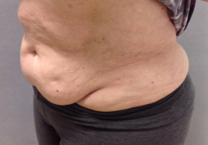 Tummy Tuck Before and After Pictures Bucks County, PA and Hunterdon County, NJ