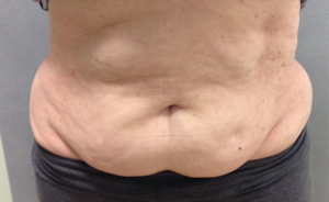 Tummy Tuck Before and After Pictures Bucks County, PA and Hunterdon County, NJ