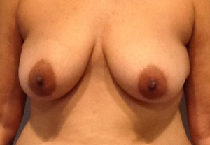 Breast Augmentation Before and After Pictures Bucks County, PA and Hunterdon County, NJ