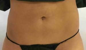 Coolsculpting Before and After Pictures Bucks County, PA and Hunterdon County, NJ