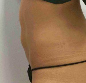 Coolsculpting Before and After Pictures Bucks County, PA, and Hunterdon County, NJ