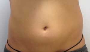 Coolsculpting Before and After Pictures Bucks County, PA and Hunterdon County, NJ