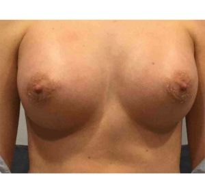 Breast Augmentation Before and After Pictures Bucks County, PA and Hunterdon County, NJ