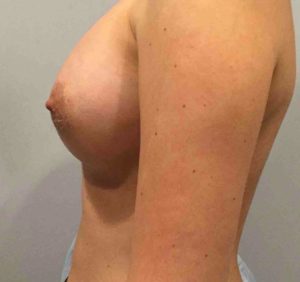 Breast Augmentation Before and After Pictures Bucks County, PA, and Hunterdon County, NJ
