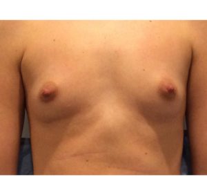 Breast Augmentation Before and After Pictures Bucks County, PA and Hunterdon County, NJ