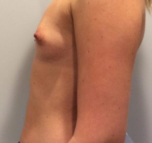 Breast Augmentation Before and After Pictures Bucks County, PA and Hunterdon County, NJ