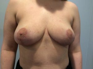 Breast Reduction Before and After Pictures Bucks County, PA, and Hunterdon County, NJ