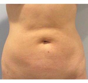 Liposuction Before and After Pictures Bucks County, PA and Hunterdon County, NJ