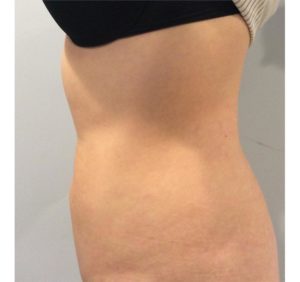 Liposuction Before and After Pictures Bucks County, PA and Hunterdon County, NJ