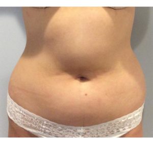 Bra Fat Liposuction with Vaser Lipo Before & After Photos New Jersey -  Reflections Center