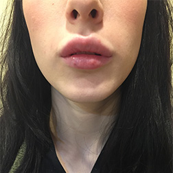 Lip Augmentation Before and After Pictures Bucks County, PA and Hunterdon County, NJ