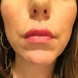 after-lip-aug-2 Lip Augmentation Before and After Pictures in Bucks County, PA, and Hunterdon County, NJ