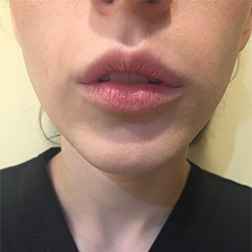 before-lip-aug-1 Lip Augmentation Before and After Pictures in Bucks County, PA, and Hunterdon County, NJ