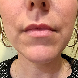 Lip Augmentation Before and After Pictures Bucks County, PA, and Hunterdon County, NJ