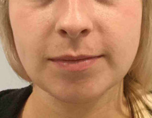 Chin Augmentation Before and After Pictures in Bucks County, PA, and Hunterdon County, NJ