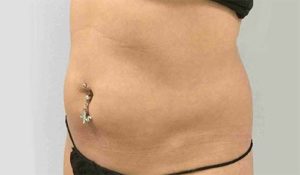 Coolsculpting Before and After Pictures Bucks County, PA and Hunterdon County, NJ