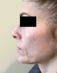 Laser Skin Resurfacing Before and After Pictures Bucks County, PA and Hunterdon County, NJ