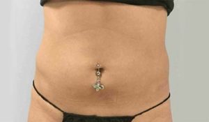 Coolsculpting Before and After Pictures Bucks County, PA and Hunterdon County, NJ