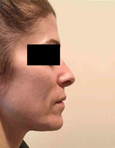 Laser Skin Resurfacing Before and After Pictures Bucks County, PA and Hunterdon County, NJ