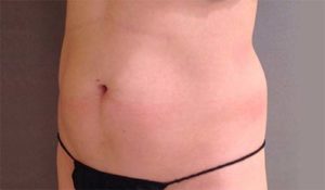 Coolsculpting Before and After Pictures Bucks County, PA and Hunterdon County, NJ