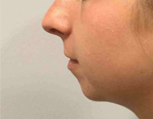 Chin Augmentation Before and After Pictures Bucks County, PA and Hunterdon County, NJ