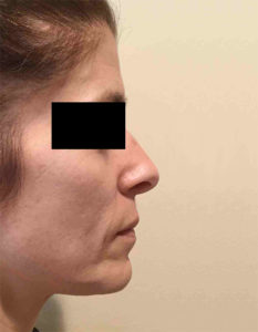 Laser Skin Resurfacing Before and After Pictures Bucks County, PA and Hunterdon County, NJ