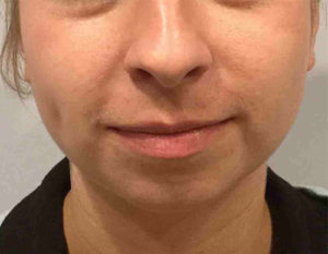 Chin Augmentation Before and After Pictures in Bucks County, PA, and Hunterdon County, NJ