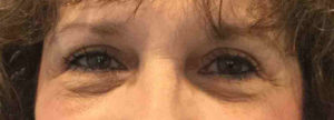 Blepharoplasty Before and After Pictures Bucks County, PA and Hunterdon County, NJ