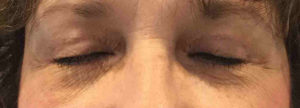 Blepharoplasty Before and After Pictures Bucks County, PA and Hunterdon County, NJ