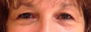 Blepharoplasty Before and After Pictures Bucks County, PA and Hunterdon County, NJ