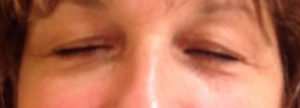 Blepharoplasty Before and After Pictures Bucks County, PA, and Hunterdon County, NJ
