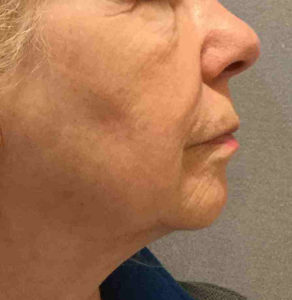 Chemical Peel Before and After Pictures Bucks County, PA and Hunterdon County, NJ