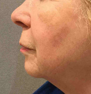 Chemical Peel Before and After Pictures Bucks County, PA and Hunterdon County, NJ