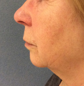 Chemical Peel Before and After Pictures Bucks County, PA, and Hunterdon County, NJ