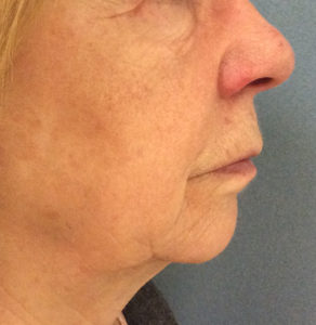 Chemical Peel Before and After Pictures Bucks County, PA and Hunterdon County, NJ