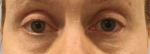 Blepharoplasty Before and After Pictures Bucks County, PA and Hunterdon County, NJ