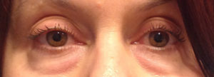 Blepharoplasty Before and After Pictures Bucks County, PA and Hunterdon County, NJ